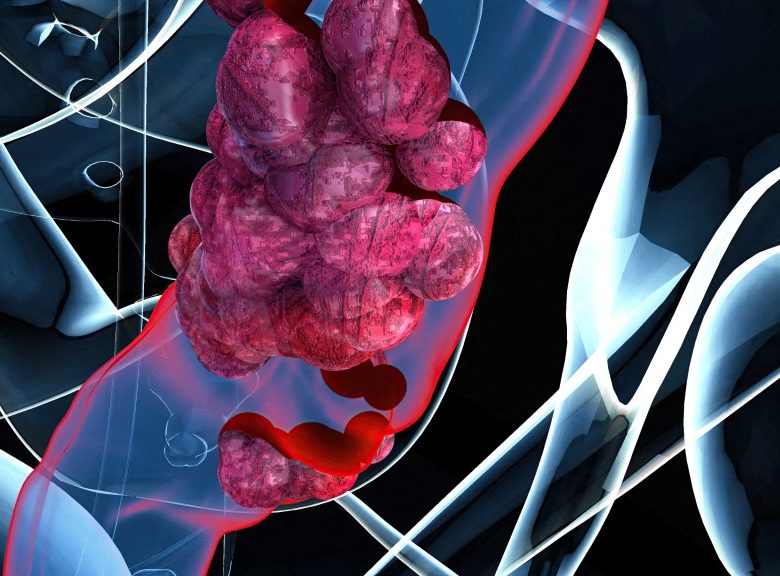 Colon cancer, conceptual illustration. (Photo by JULIEN TROMEUR/SCIENCE PHOTO LIB / JTO / Science Photo Library via AFP)